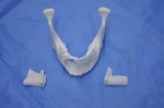 我省首例用3D打印技术修复下颌体缺损手术顺利完成 - 青海热线