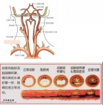 剥除颈动脉斑块，预防缺血性中风
青海省人民医院神经外科稳步开展颈动脉内膜剥脱手术 - Qhnews.Com